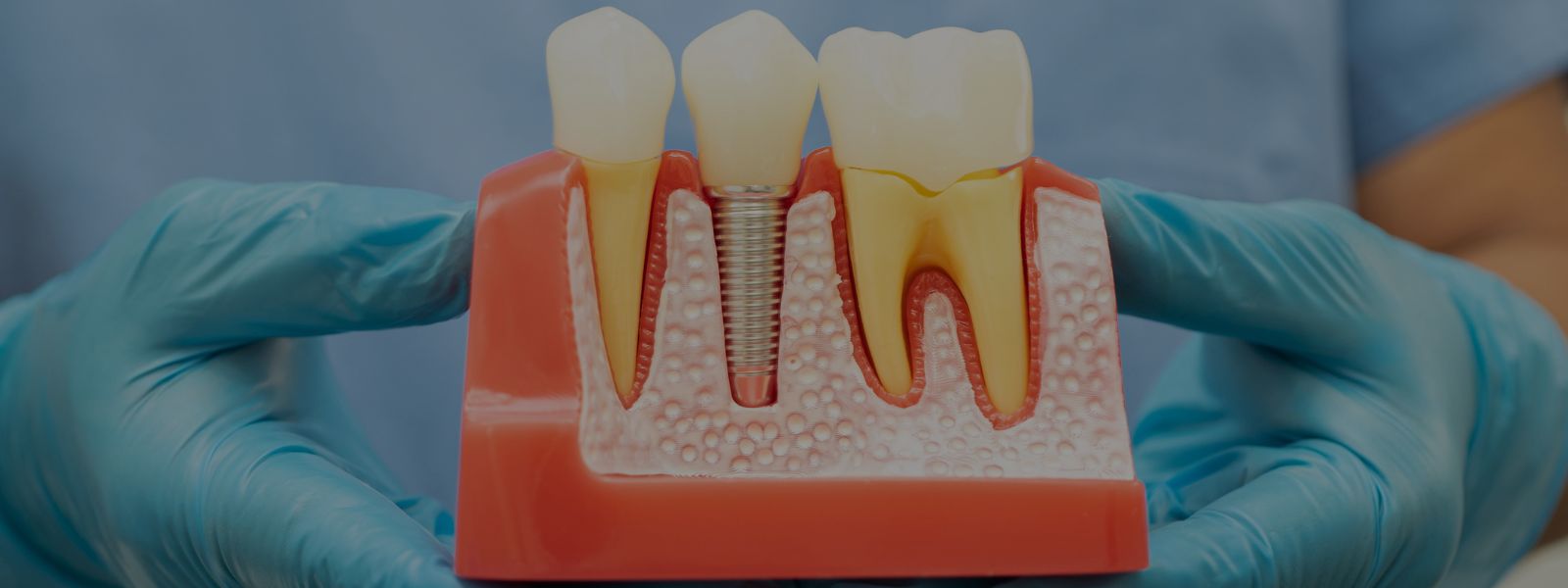 implantes dentales