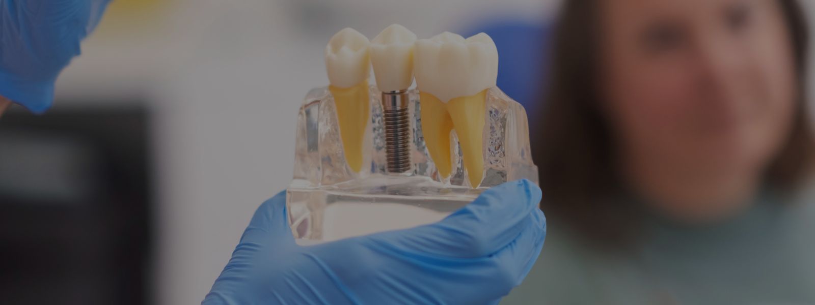 implantes dentales